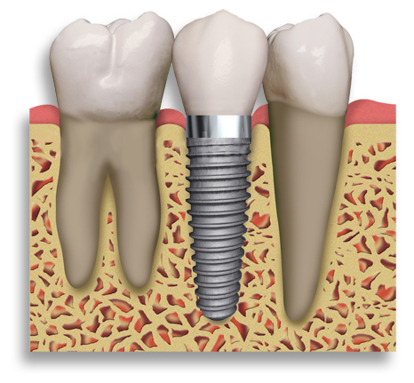 Implante de Dente - Dentista Campinas - Implante dentário - Benefícios e Vantagens